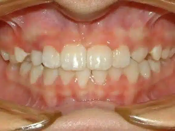 Orthodontic case, after treatment