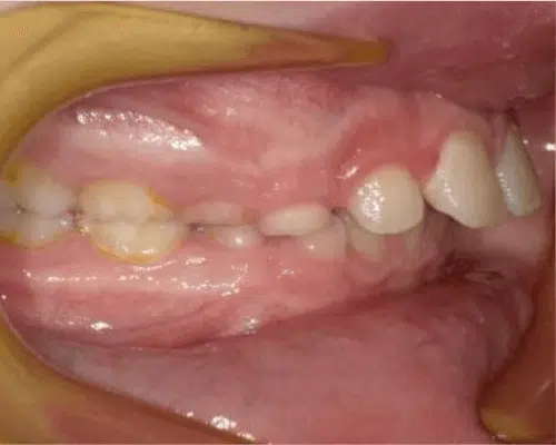 Orthodontic case, before treatment