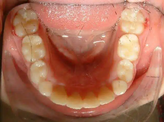 Orthodontic case, after treatment