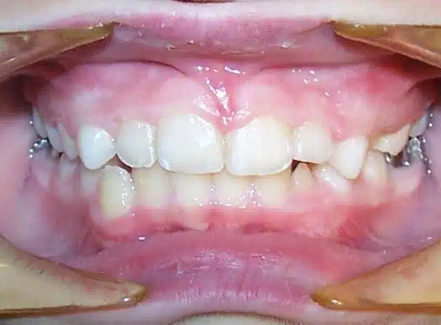 Orthodontic case, after treatment
