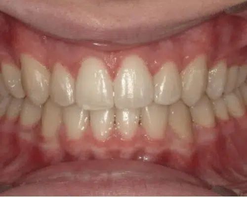 Orthodontic case, after treatment