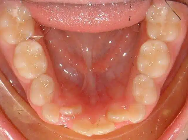 Orthodontic case, before treatment