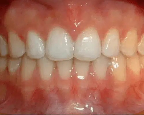 Orthodontic case, after treatment