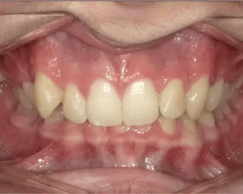 Orthodontic case, before treatment