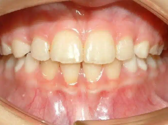 Orthodontic case, after treatment