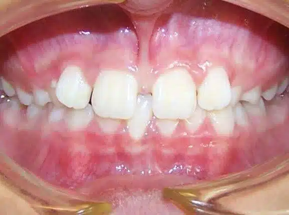 Orthodontic case, before treatment