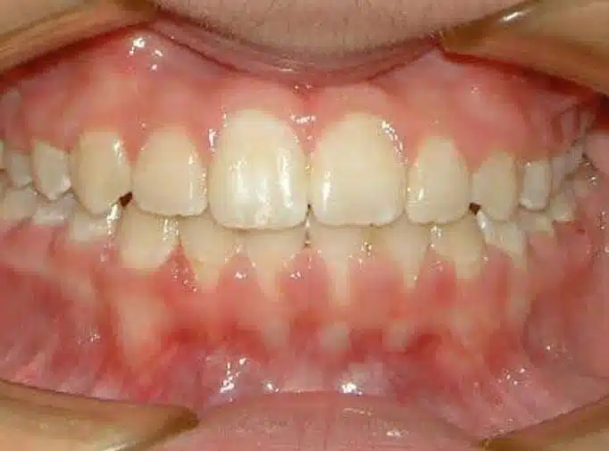 Orthodontic case, after treatment