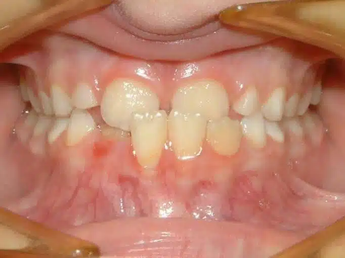 Orthodontic case, before treatment