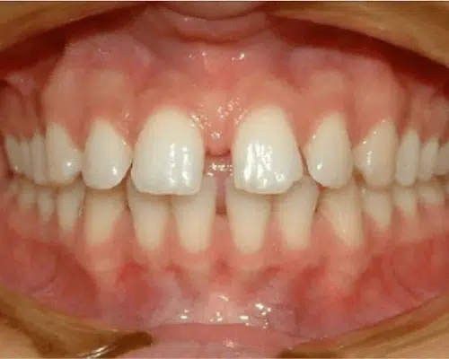 Orthodontic case, before treatment