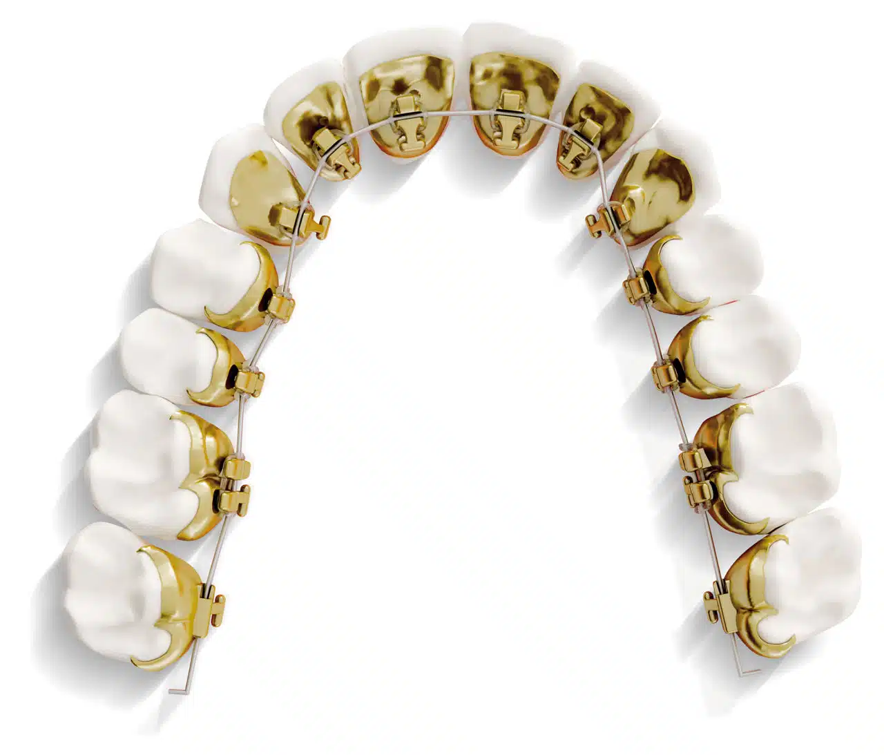 Lingual braces placed behind teeth