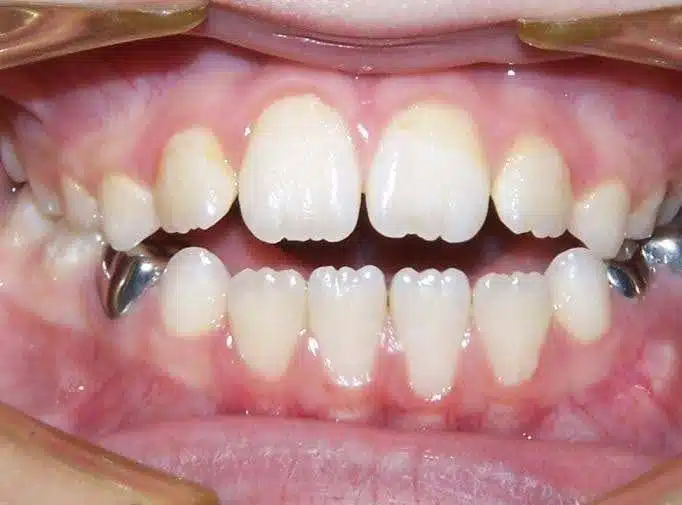 Orthodontic case, before treatment