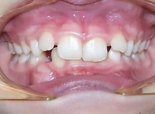 Orthodontic case, before treatment