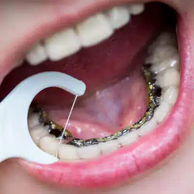 how lingual braces align teeth from behind
