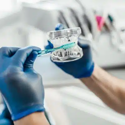 Patient smiling with hidden lingual braces applied