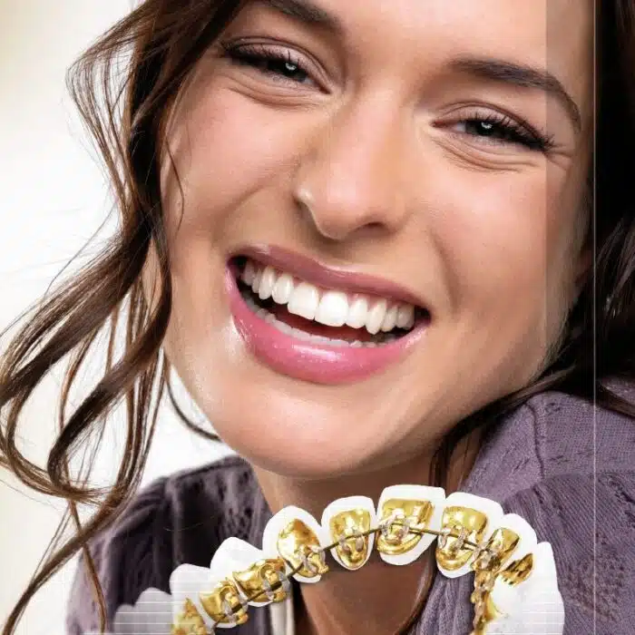 Comparison of traditional vs lingual braces