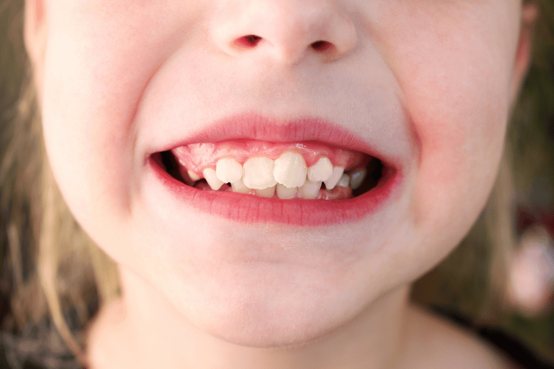 orthodontist examining crowded teeth Closter