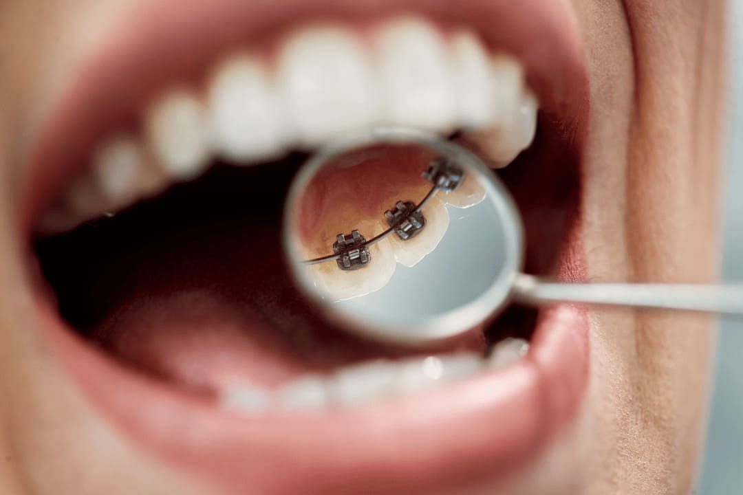 hidden orthodontic treatment