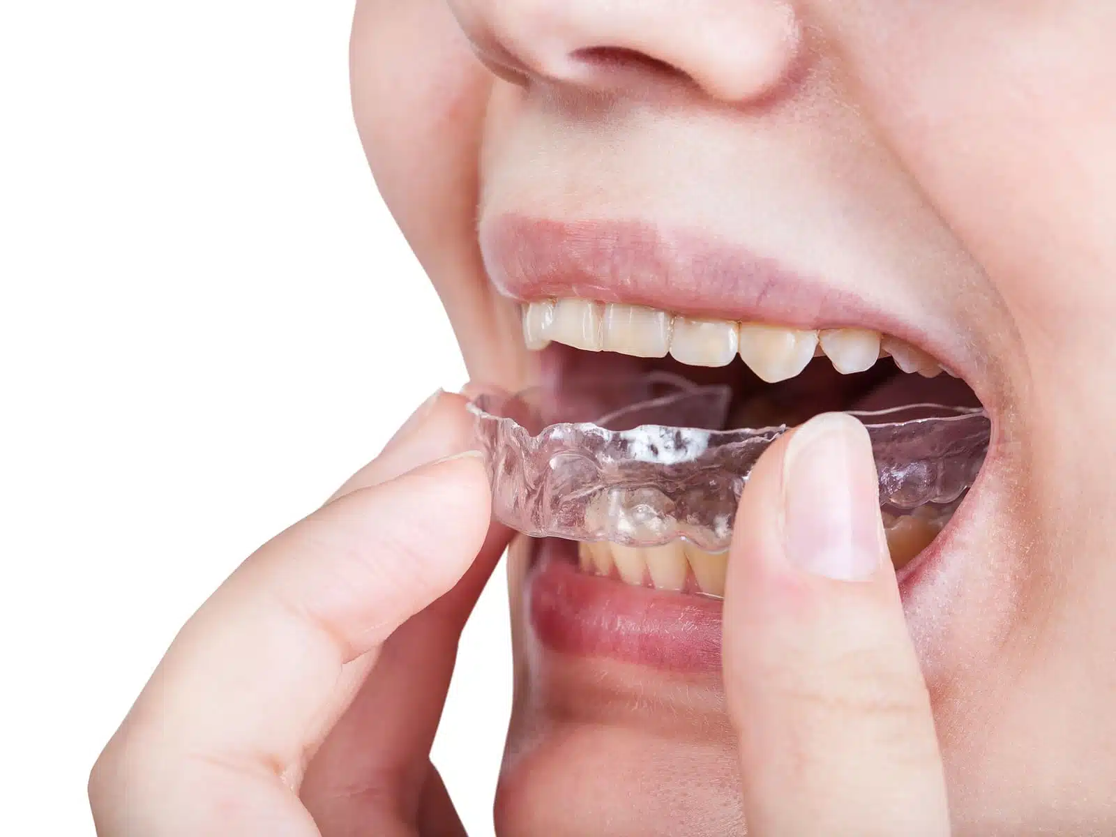 Are clear aligners in Closter, NJ the right treatment for you
