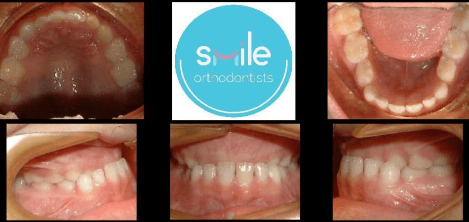 Matthew teeth before orthodontic treatment