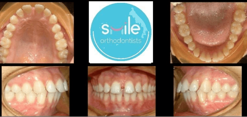Ben teeth before orthodontic treatment
