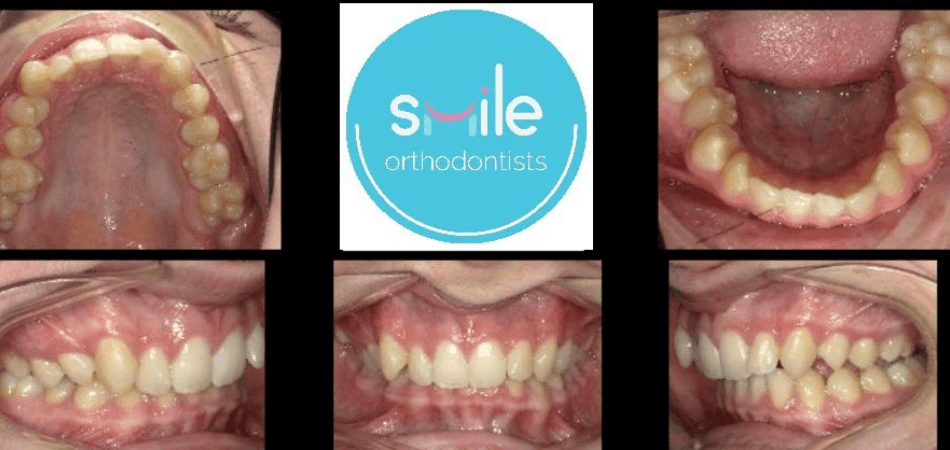 Noah teeth before orthodontic treatment