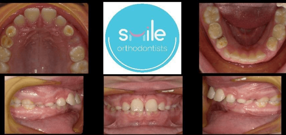 Rachel teeth before orthodontic treatment