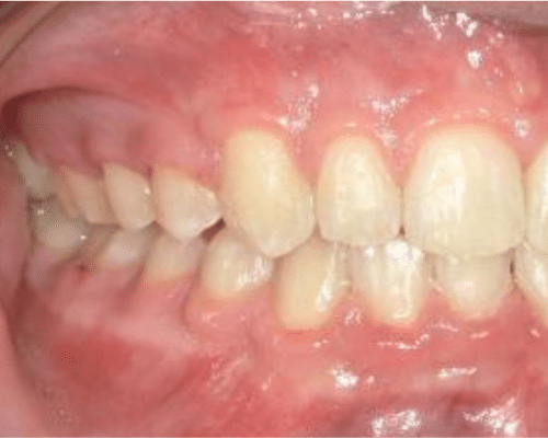 Matthew after treatment
