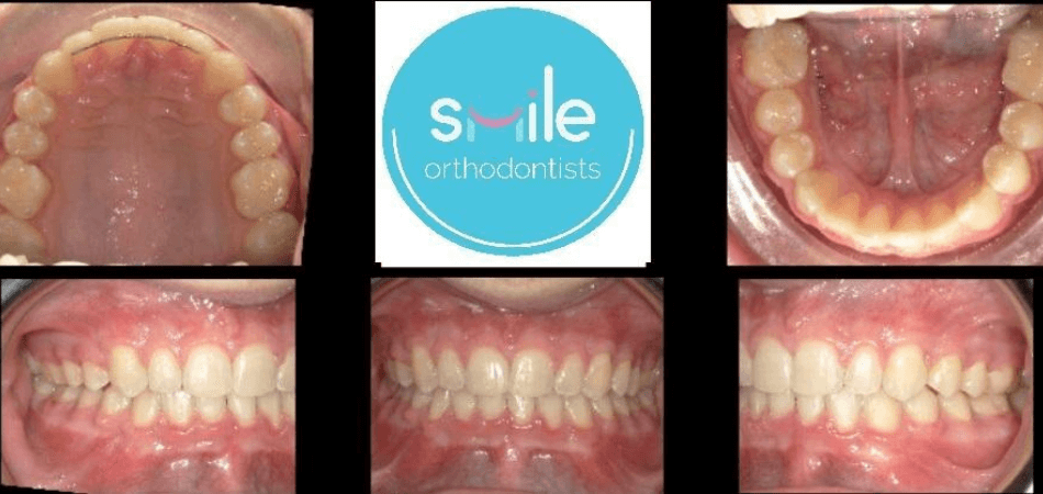 Matthew teeth after orthodontic treatment
