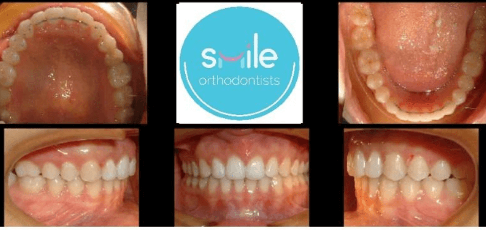 Ben teeth after orthodontic treatment