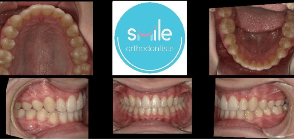 Noah teeth after orthodontic treatment