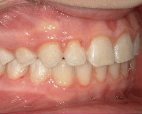 Rachel after treatment