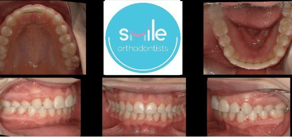 Rachel teeth after orthodontic treatment