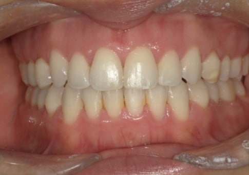 Franco after treatment