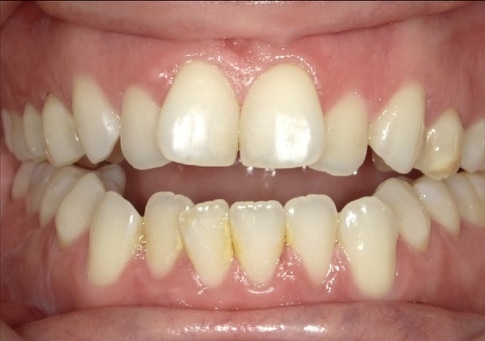 Franco before treatment
