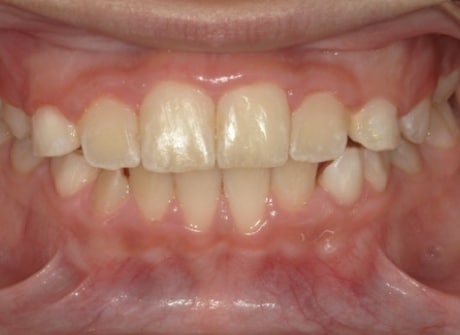 Erick after treatment
