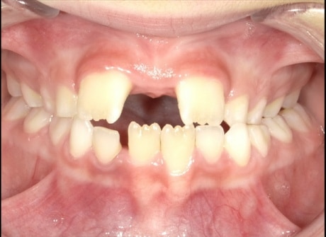 Erick before treatment