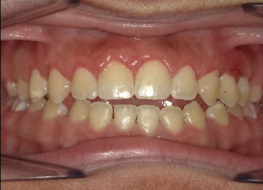 Pichardo teeth after orthodontic treatment