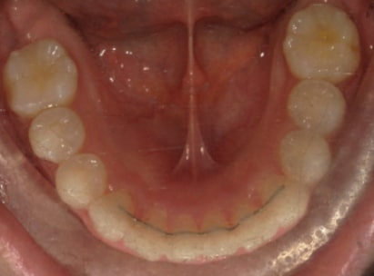 Raphael after treatment