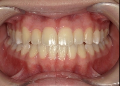Mia after treatment