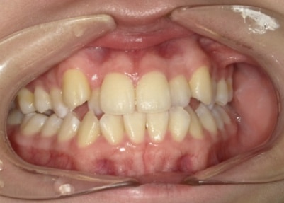 Mia before treatment