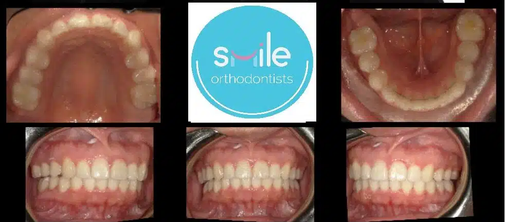 Raphael teeth after orthodontic treatment