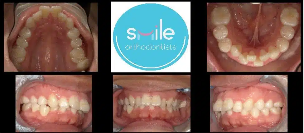 Raphael teeth before orthodontic treatment