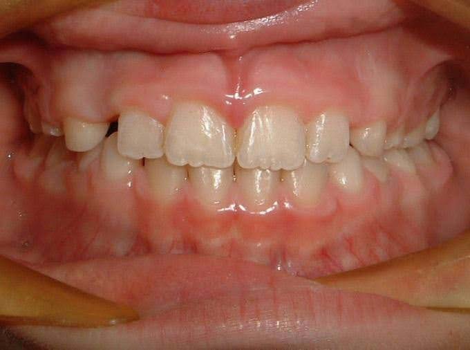 Crossbite after orthodontic treatment