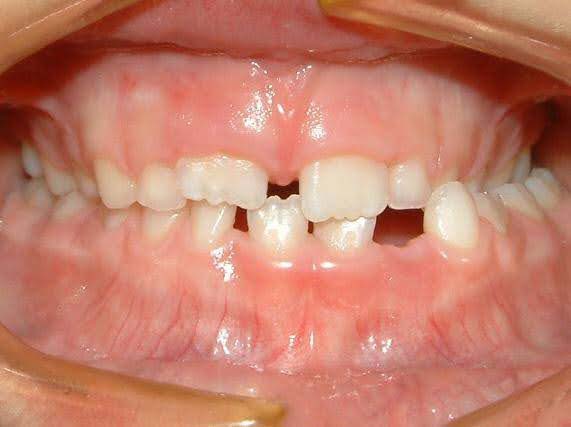 Crossbite before orthodontic treatment