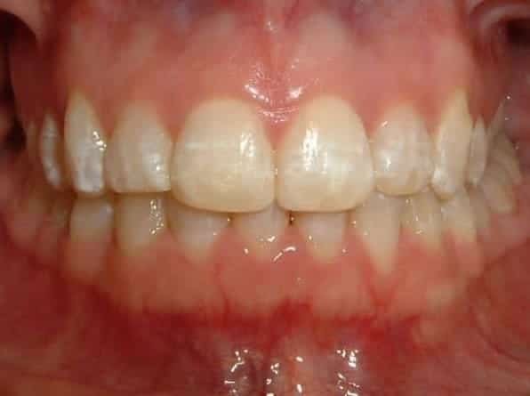 Front Crossbite after orthodontic treatment