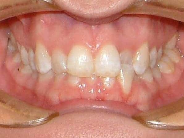 Front Crossbite before orthodontic treatment