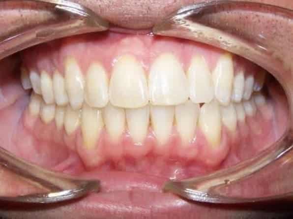 Edge-to-Edge Front Teeth after orthodontic treatment