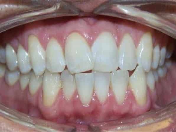 Edge-to-Edge Front Teeth before orthodontic treatment