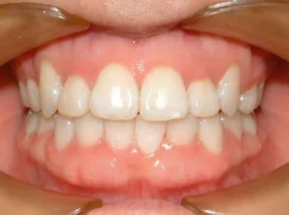 Crowded teeth after orthodontic treatment
