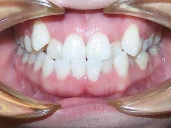 Crowded teeth before orthodontic treatment